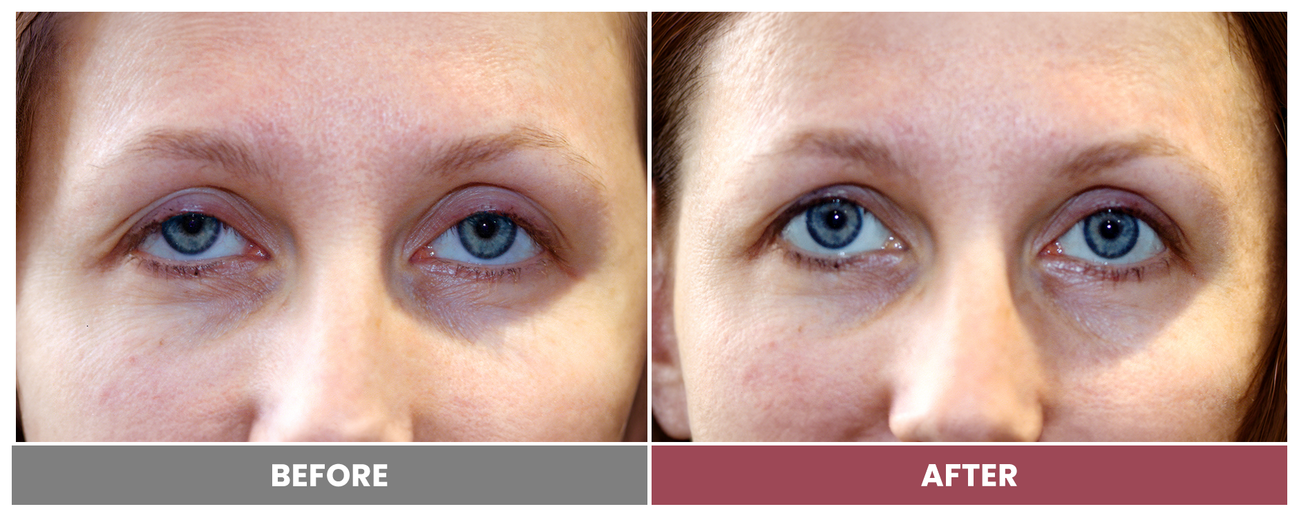 PTOSIS REPAIR - Case 20